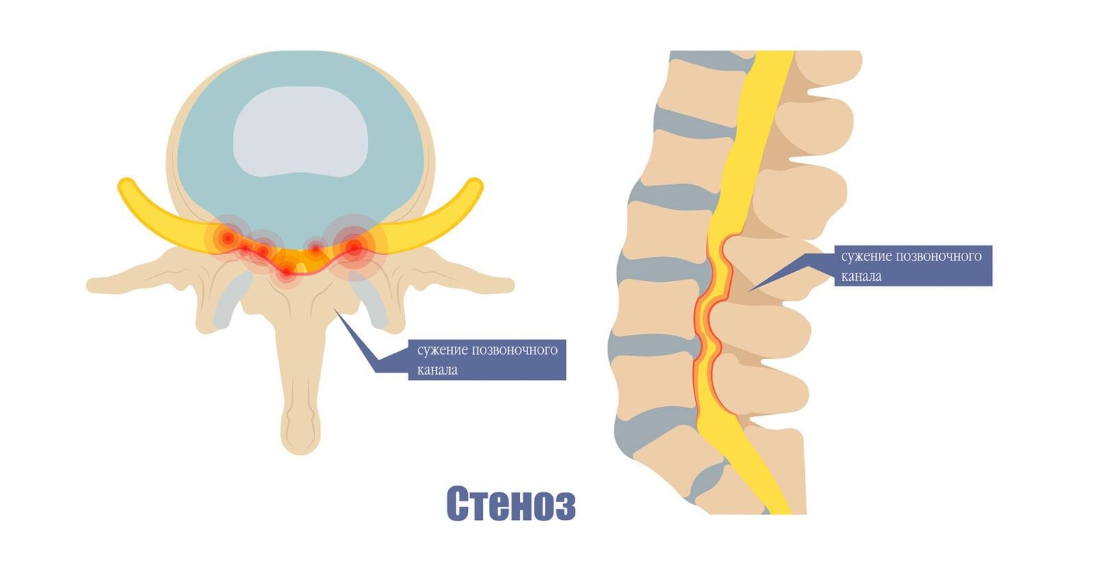 Стеноз позвоночного канала поясничного отдела в картинках