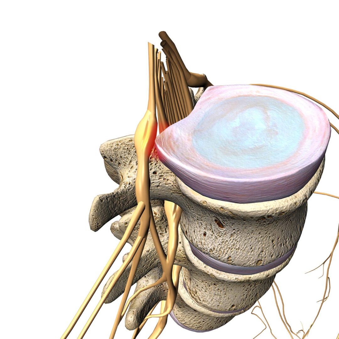Боль при грыже позвоночника - Клиника Вертеброневрологии