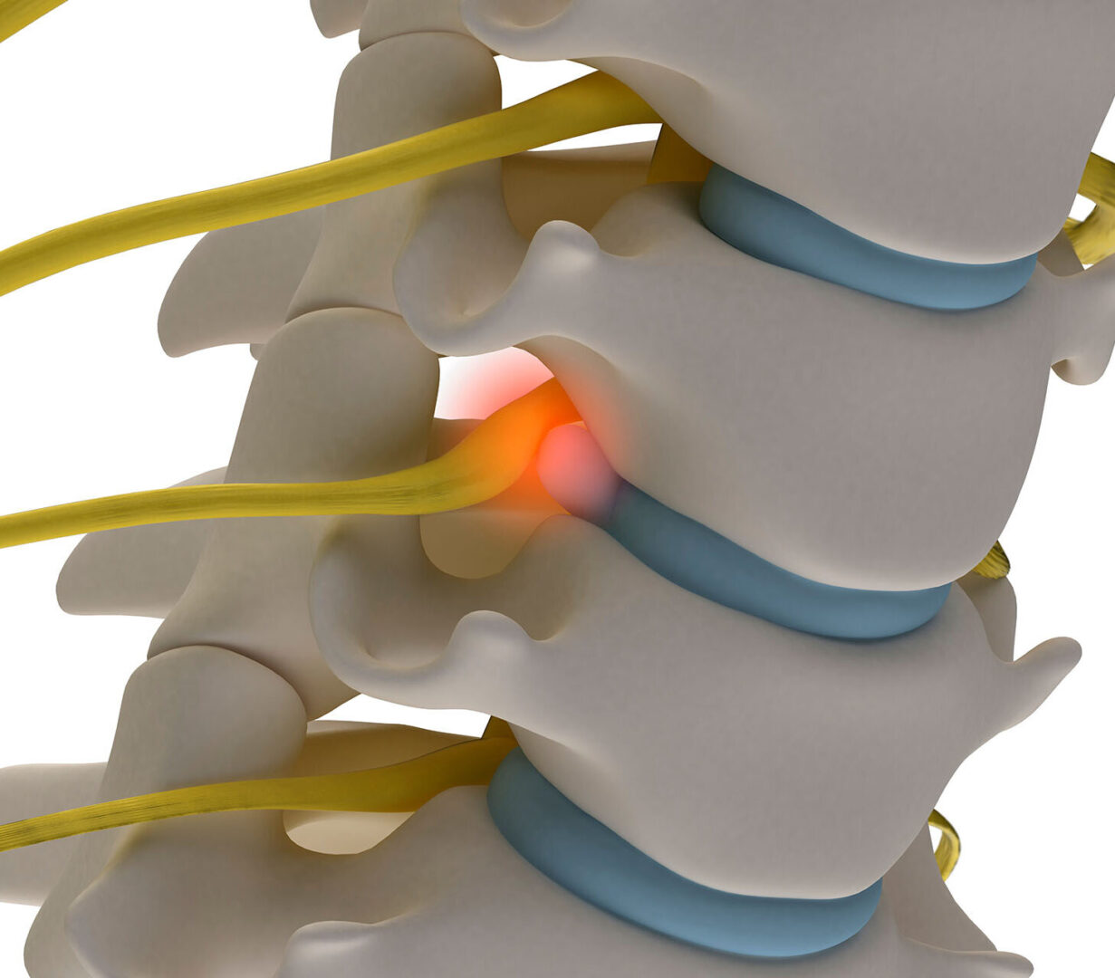 Что будет если не лечить грыжи позвоночника? - Блог