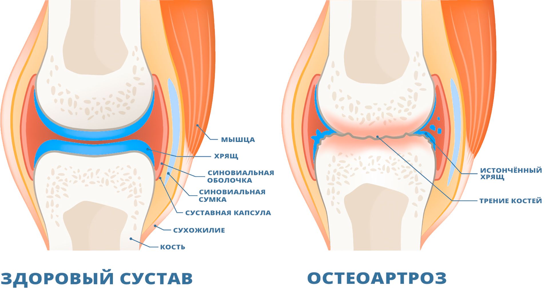 Остеоартроз суставов - Клиника Вертеброневрологии